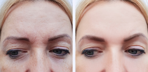Antes e depois